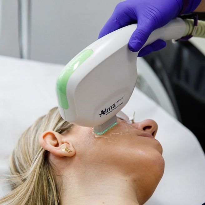 Alma Dye VL Intense Pulsed Light